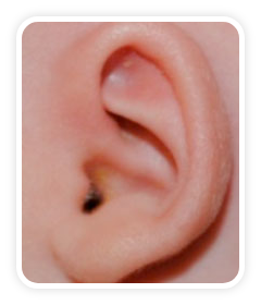 After photo of a Cryptotia deformity on a a baby's ear