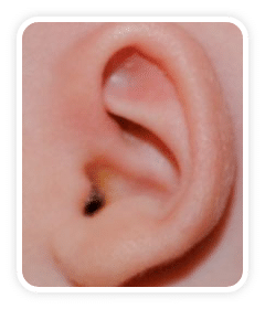 After photo of a Cryptotia deformity on a a baby's ear