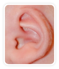Before photo of a Cryptotia deformity on a a baby's ear