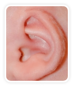 Before photo of a Cryptotia deformity on a a baby's ear