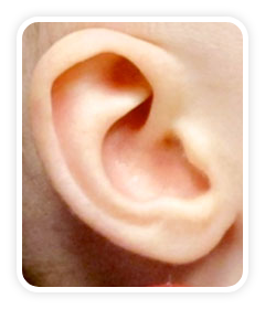 After photo of a helical rim deformity on a baby's ear