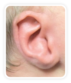 Before photo of helical rim deformity on a baby's ear