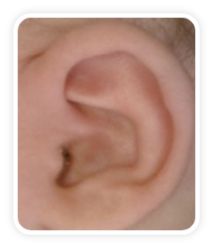 After photo of prominent ears on a baby