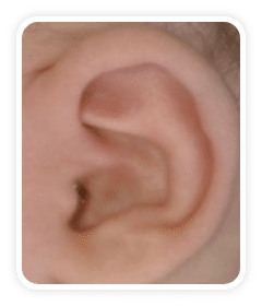 After photo of prominent ears on a baby