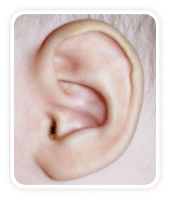 After photo of Stahl's Deformity on a baby's ear