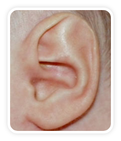 Before photo of Stahl's Deformity on a baby's ear