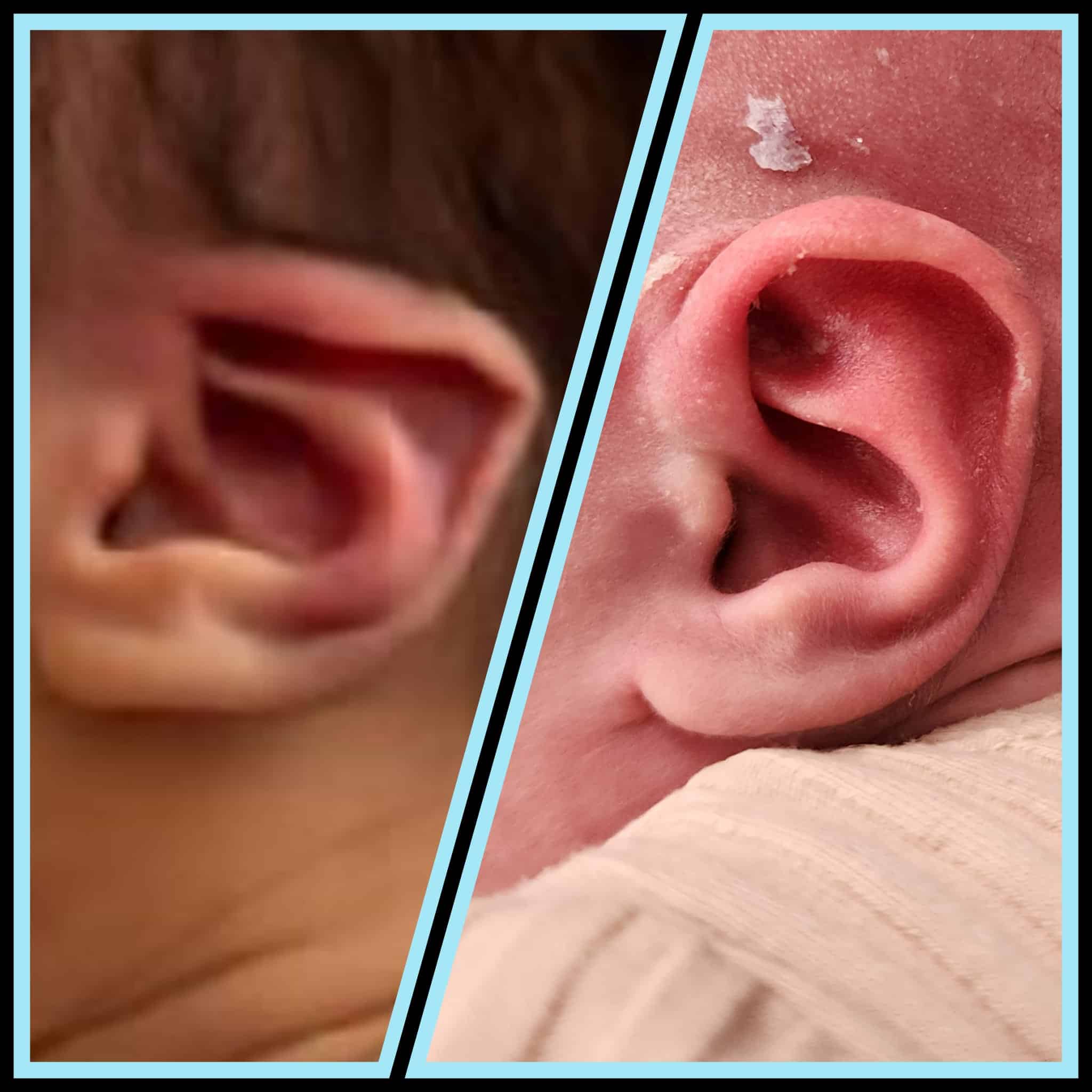 Case Studies Infant Ear case-studies-infant-ear